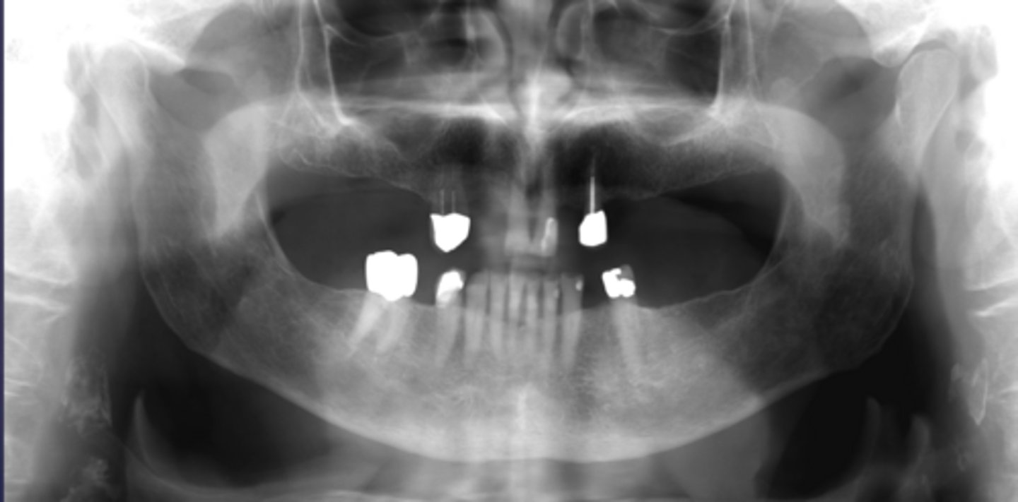 <p>What would be a differential diagnosis for this lesion?</p>