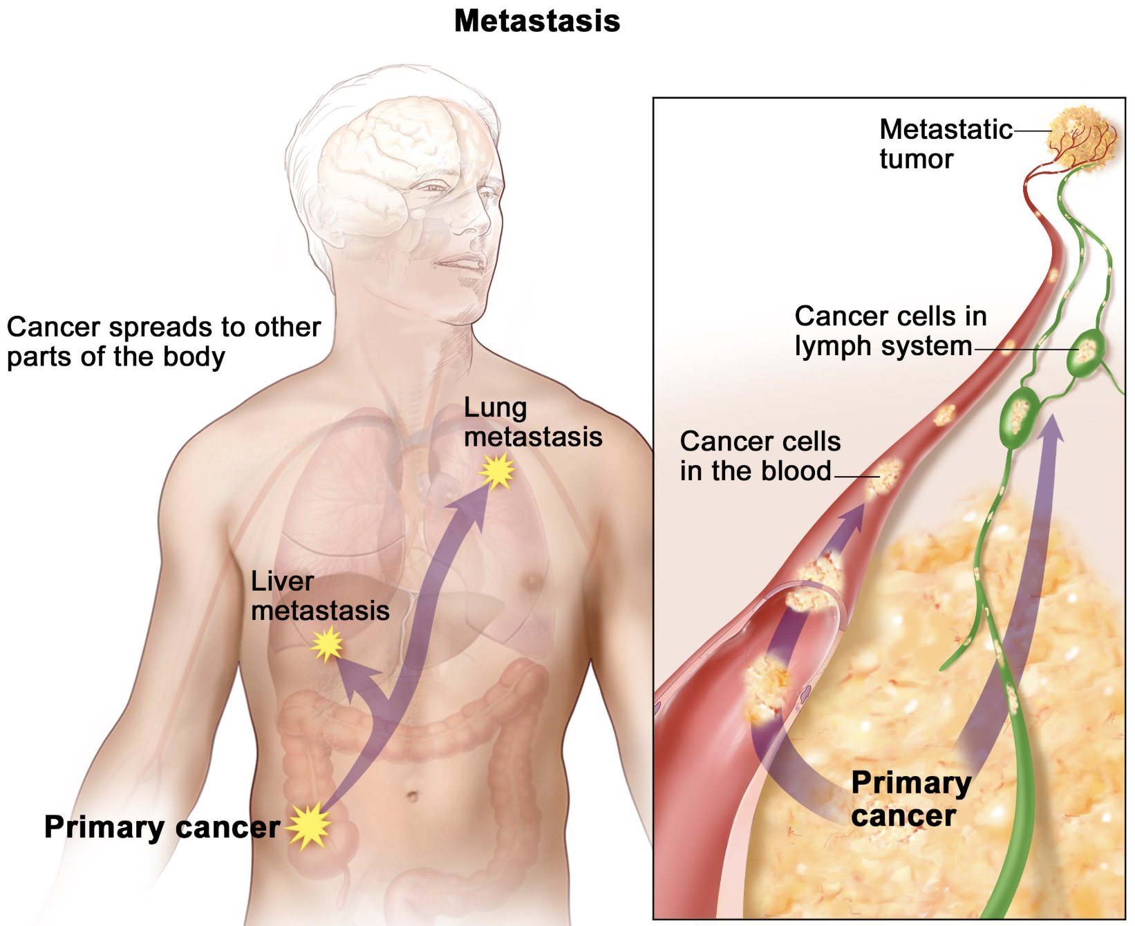 <p>The spreading of cancer cells to other parts of the body.</p>