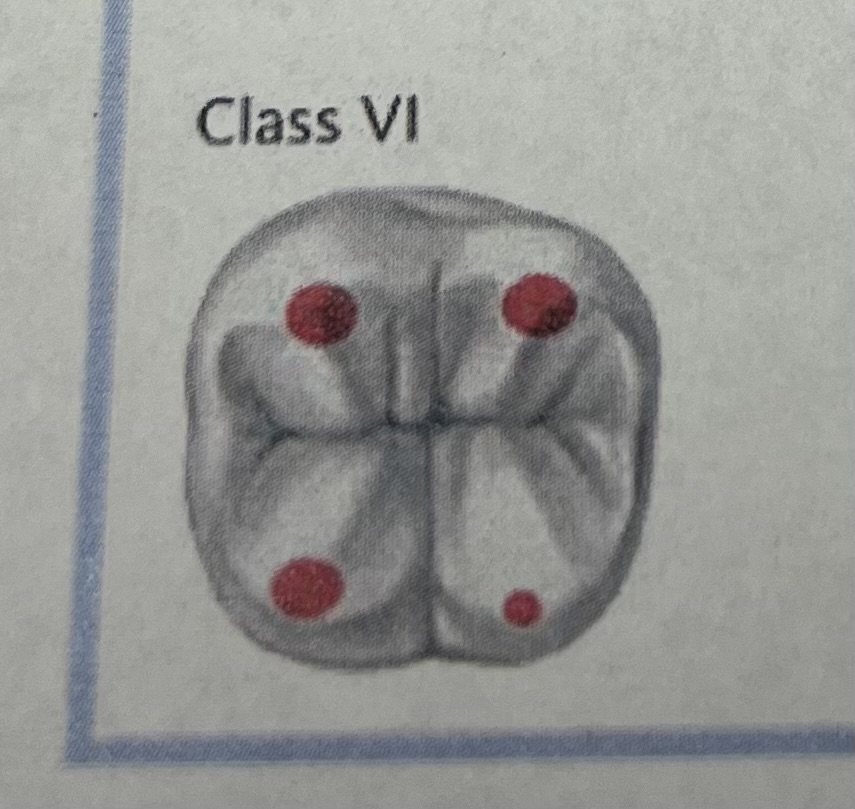 <p>Decay on incisal edges of anterior teeth, often from grinding  *<em>newest class</em>*</p>