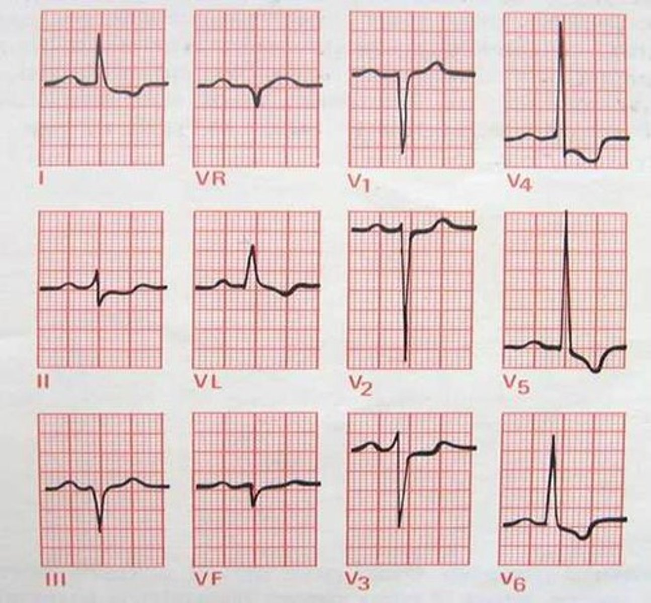 <p>Which Arrythmia is this?</p>