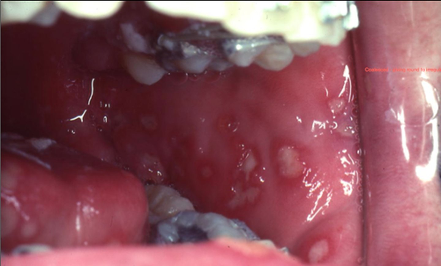 <p>-at early age</p><p>-systemic symptoms</p><p>-vessicles followed by ulcers which may involved both keratnized and non-keratinized tissue</p><p>-punched out erosions in gingiva</p>