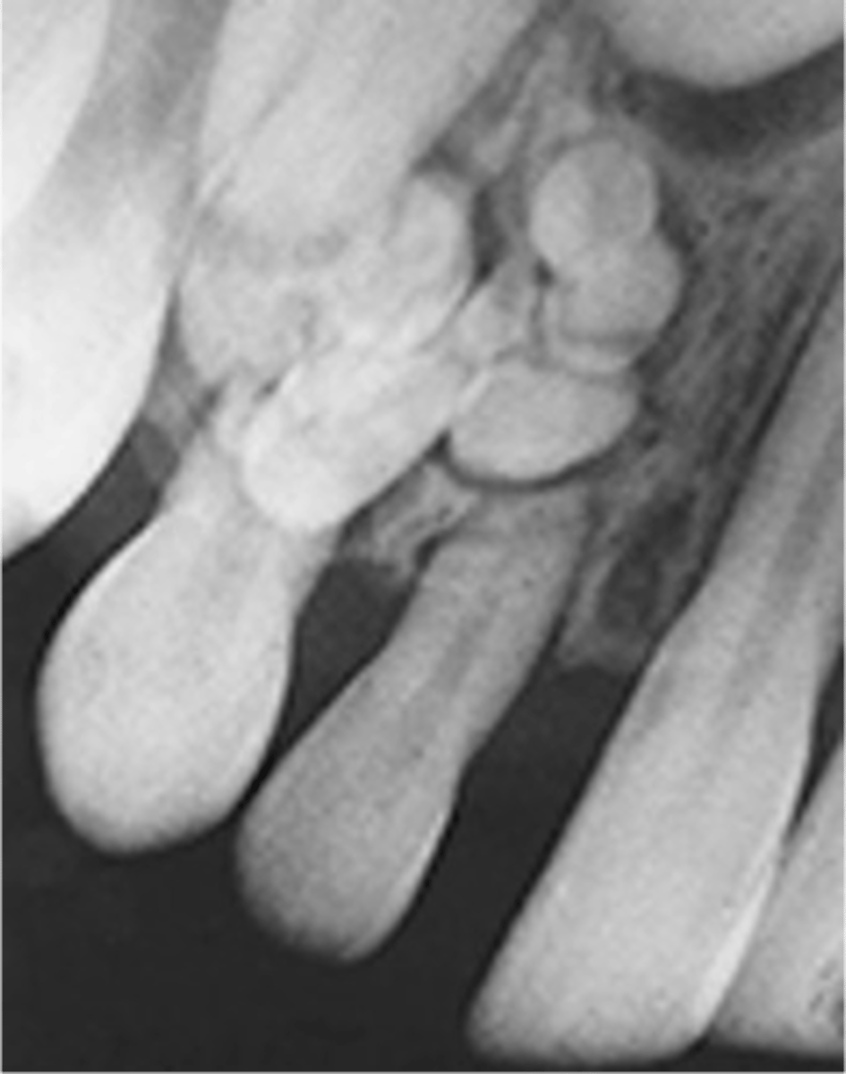 <p>- Small radiopaque masses</p><p>- Usually in the anterior jaw</p><p>- Resemble an accumulation of small teeth</p>
