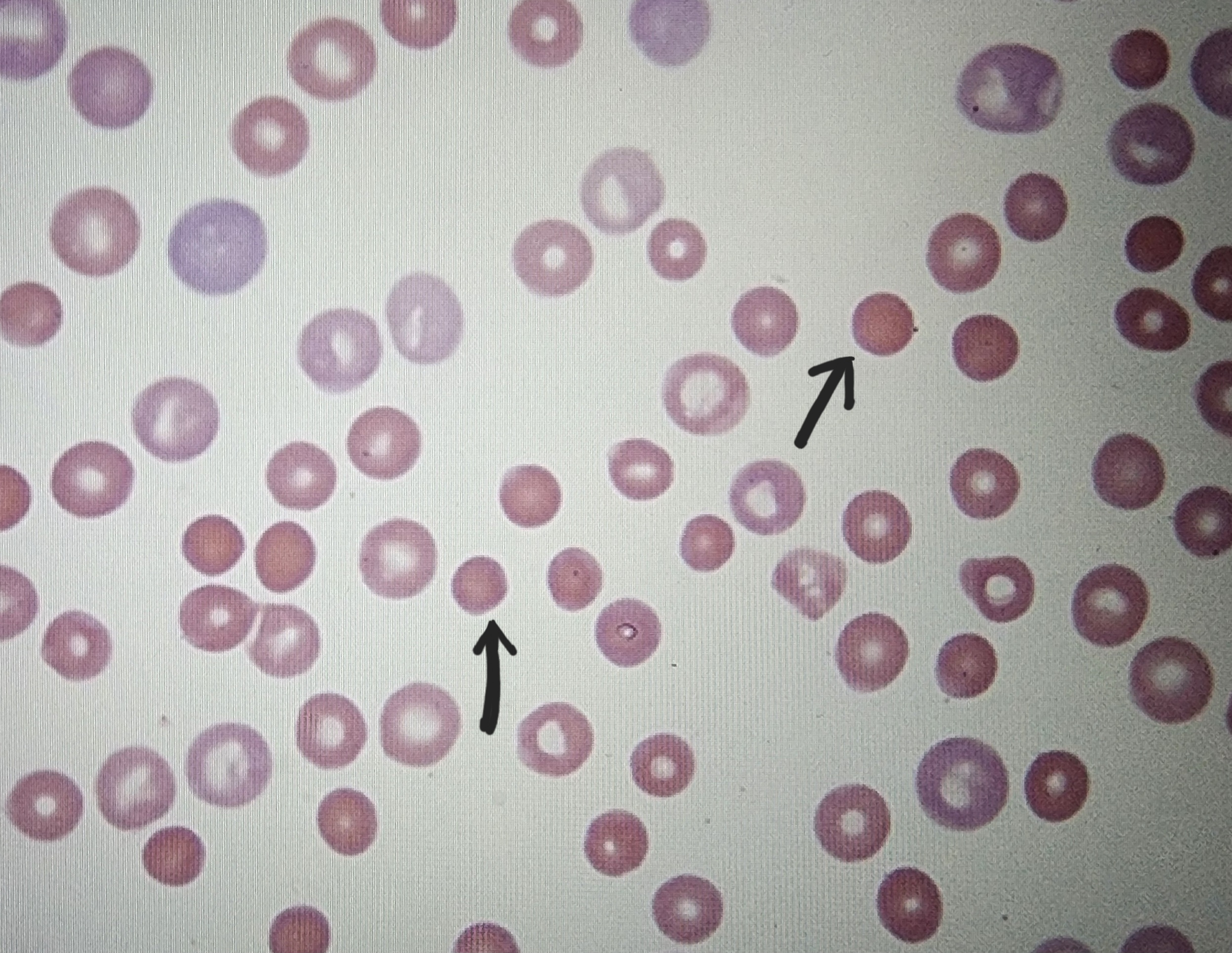 <p>has hyperchromatophil</p>