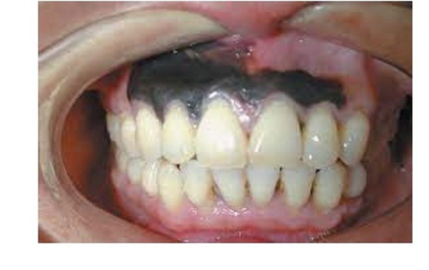 <p>A malignant tumour of melanocytes. Most arise on the skin in response to prolonged exposure to sunlight. Usually rapidly enlarging black-to-blue mass. And aggressive tumour with unpredictable behaviour and early metastasis. Most common intraoral locations are palate and max gingiva. Adults over 40.</p>