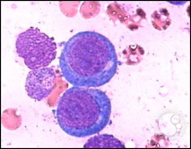 <ul><li><p>size: 18-20 micrometers</p></li><li><p>NC ratio: 6:1 (big nucleus)</p></li><li><p>chromatin: fine texture, deep violet color</p></li><li><p>Cytoplasm: dark blue, purple</p></li></ul><p></p>