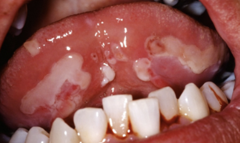 <p>Een mucocutane afwijking door een auto-immuunstoornis. Het klinisch beeld hierbij is epitheliale blaren.</p>