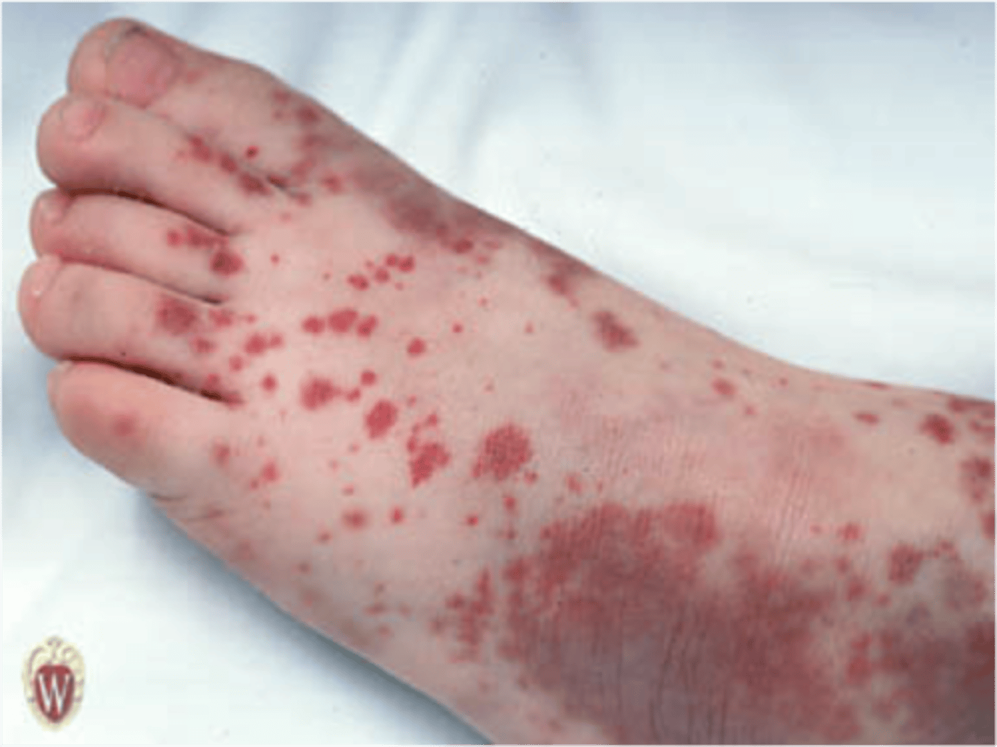 <p>Purple areas of bruising under the skin</p>