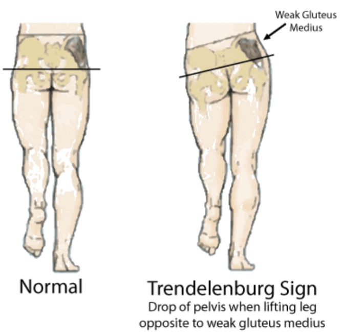 <p>uneven pelvic tilt when walking, one gluteus medius muscle significantly weaker and causes whole pelvis to tilt down on opposite </p>