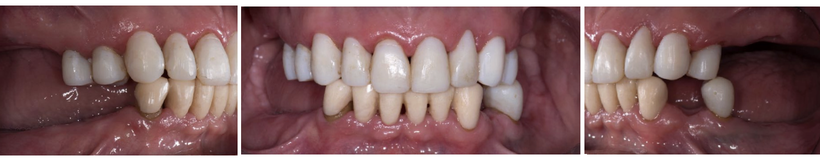 <p>additional surgical augmentation of the ridge </p>