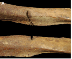 <p>penetrating wound from tip/point of sharp instrument that impacts bone will result in compression of outer table of bone to produce gouge impact (certain bones, like cranial vault, may capture rather accurate replica of knife tip)</p>