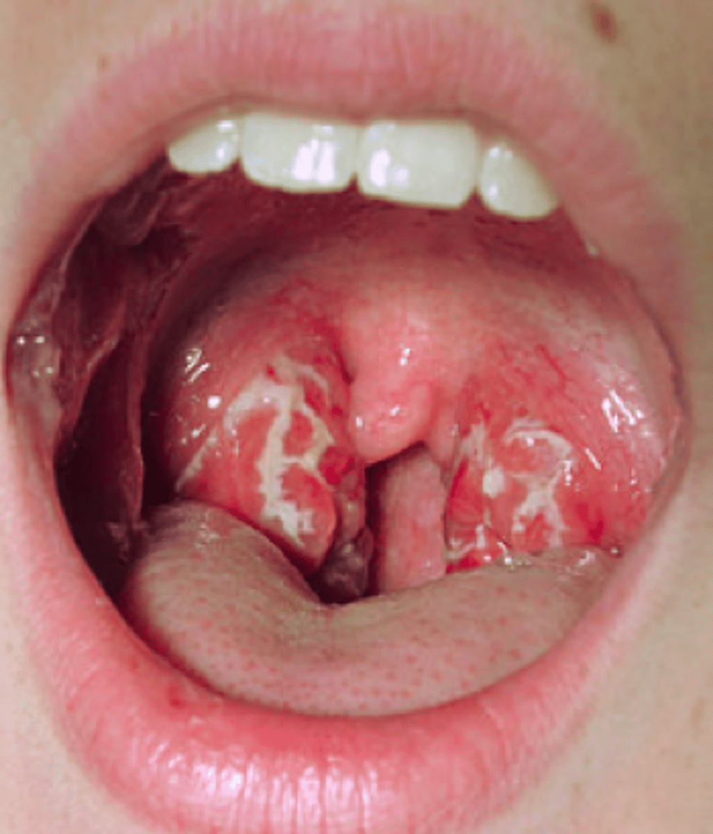 <p>Severe symptoms, leads to rheumatic fever if untreated</p><p>sudden fever, red swollen tonsils, white spots</p>