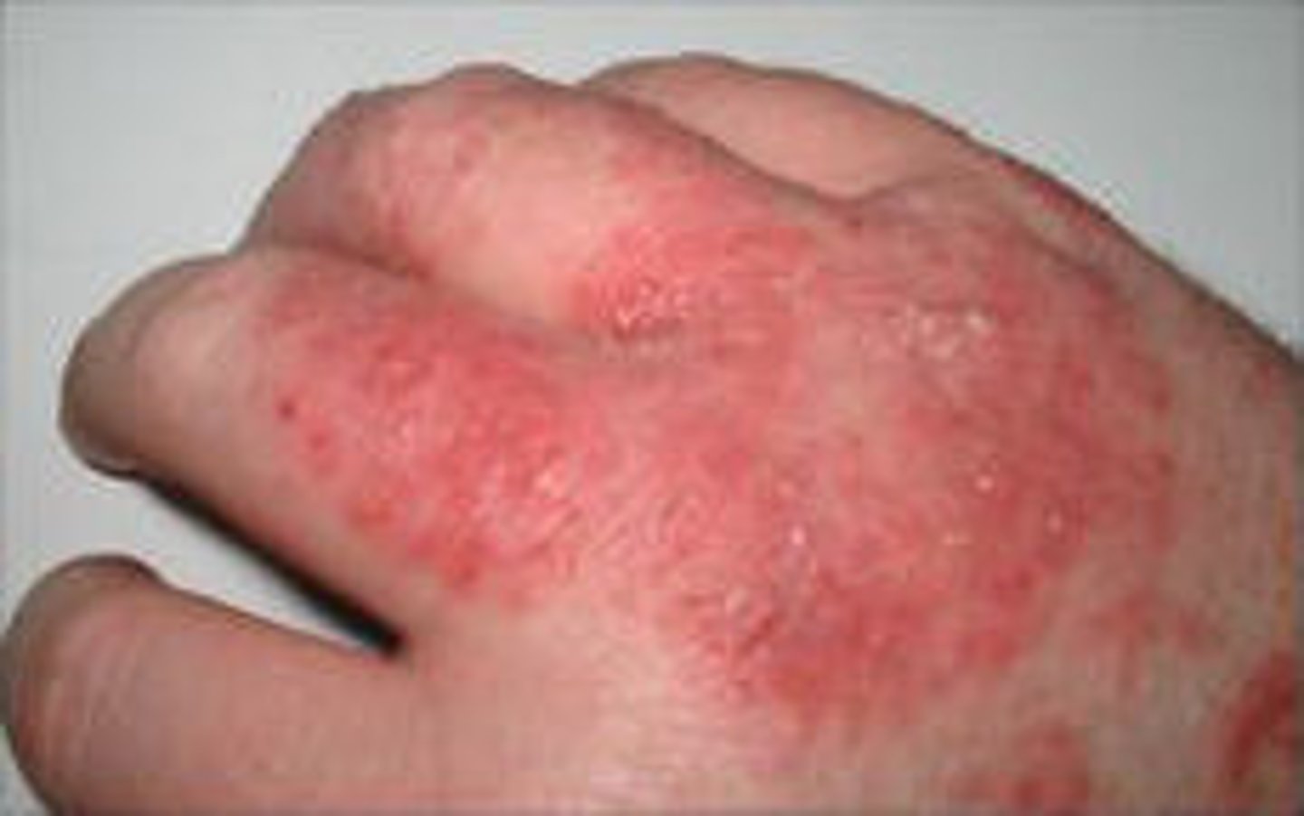 <p>redness of the skin caused by swelling of the capillaries</p>