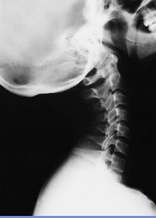 <p>What is this x-ray demonstrating?</p>
