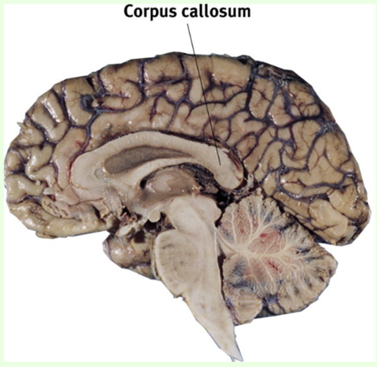 <p>a large bundle of axons that interconnects corresponding regions of the association cortex on each side of the brain</p>
