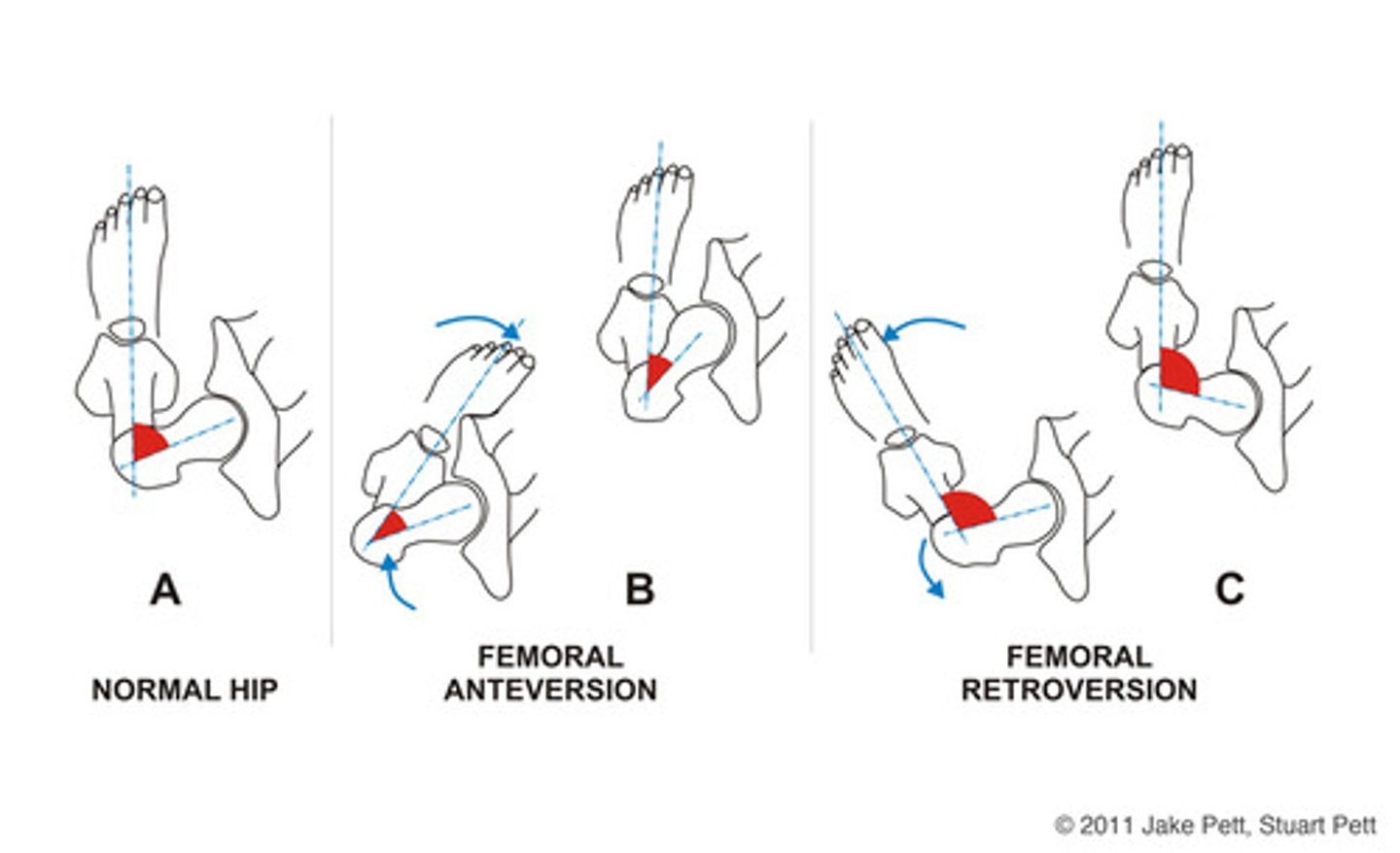 <p><15 deg femoral neck torsion (usually less than 8 is considered)</p><p>normal is 8-15 deg</p>