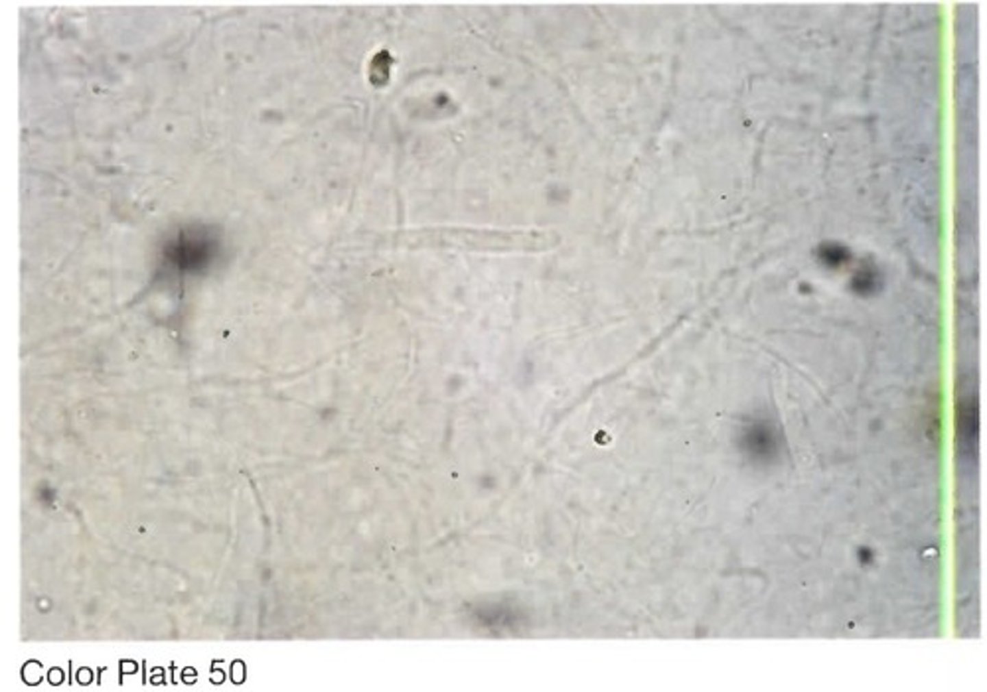 <p>D. Hyaline casts and mucus; normal</p><p>sediment</p>