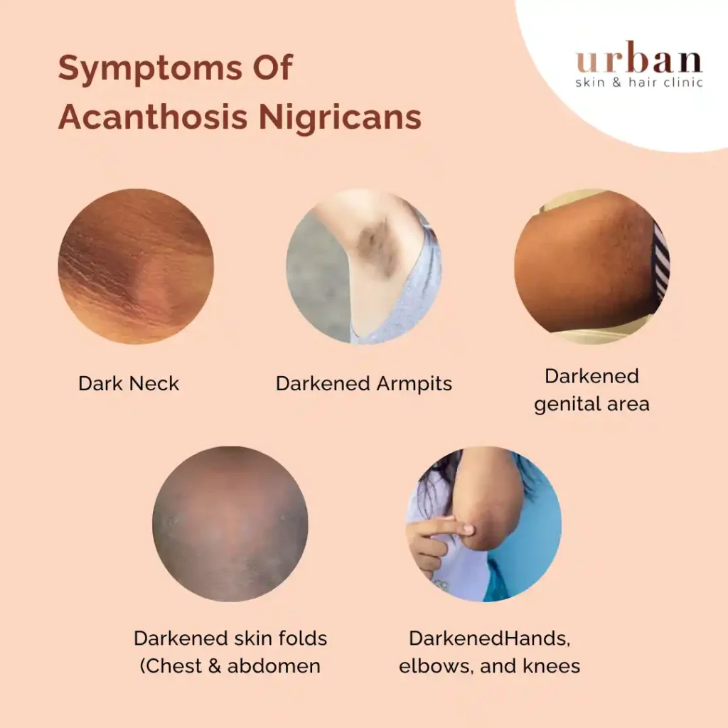 <p>E: diabetes mellitus<br>non-obese aged pt over 40→GI carcinoma</p><p>CM: plaque<br>hyperpigmented<br>velvet-textured<br>-posterior neck<br>-axillae</p><p>TX:<br>NP: weight loss<br>tx underlying disorder</p><p>MX: topical retinoids</p>