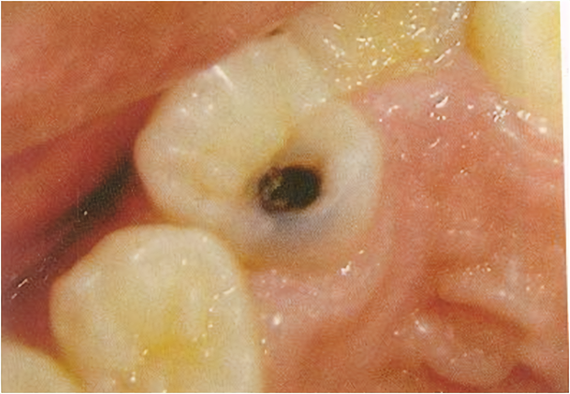<p><span><strong>affect the cusp tips of posterior teeth and the incisal edges of anterior teeth, often resulting from abrasion, erosion, or attrition.</strong></span></p>
