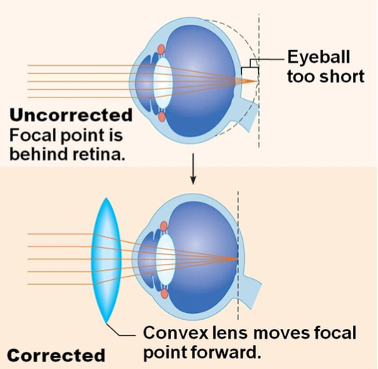 <p>Farsightedness; difficulty seeing close objects when focal point of light rays falls behind the retina</p>