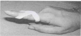 <p>Name this orthosis. What deformity can it be used to treat?</p>