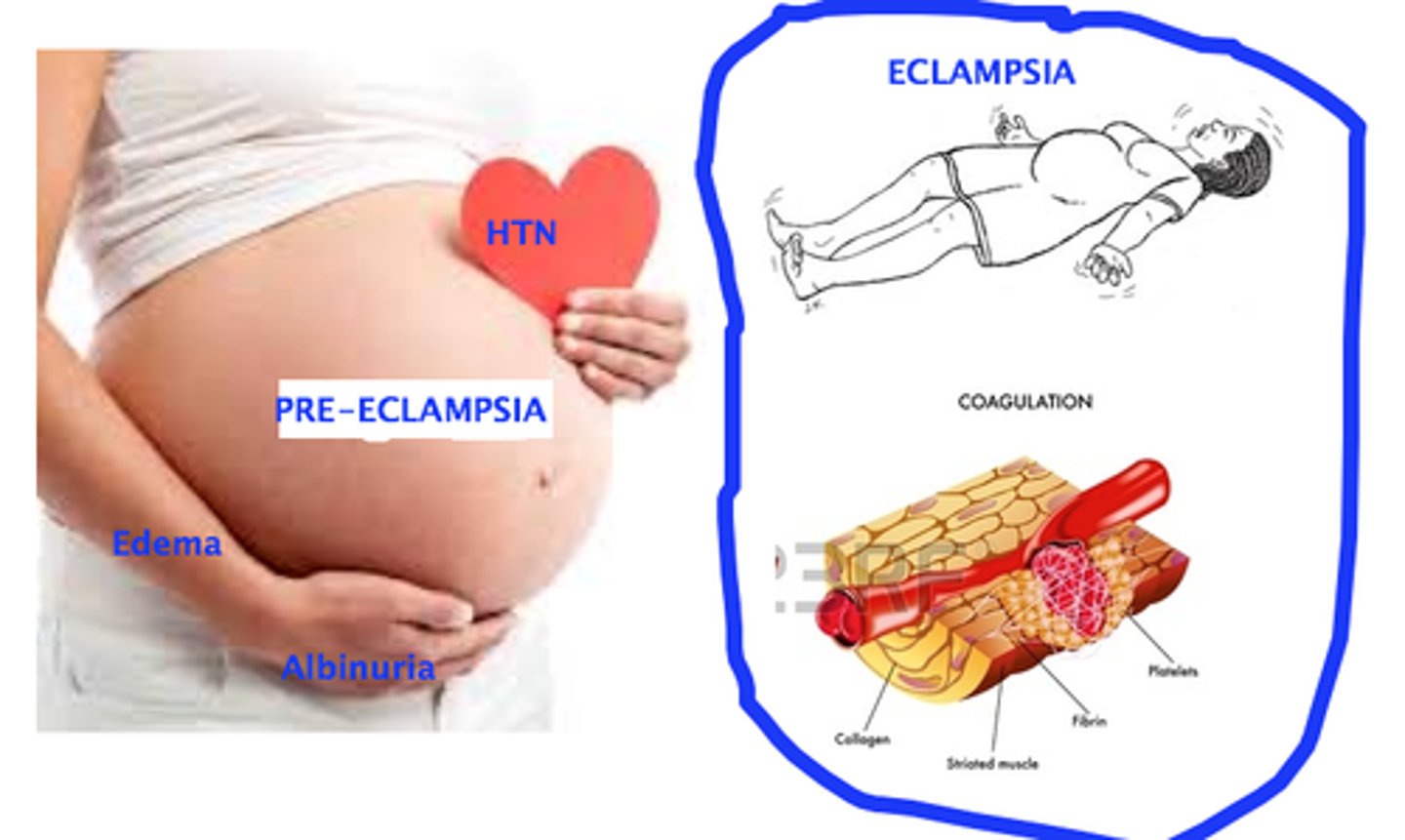 <p>severe complication and progression of preeclampsia characterized by convulsion.</p>