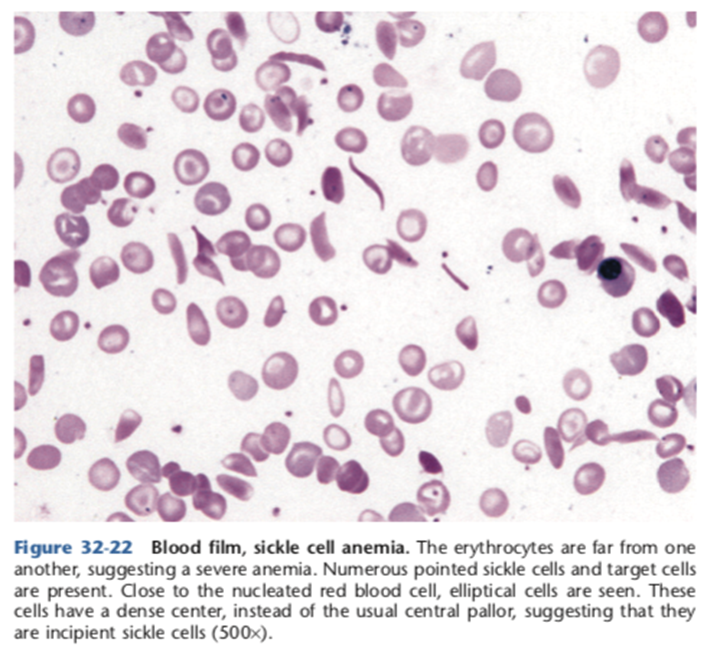 ¿Qué se ve en un frotis sanguíneo en anemia por células falciformes?