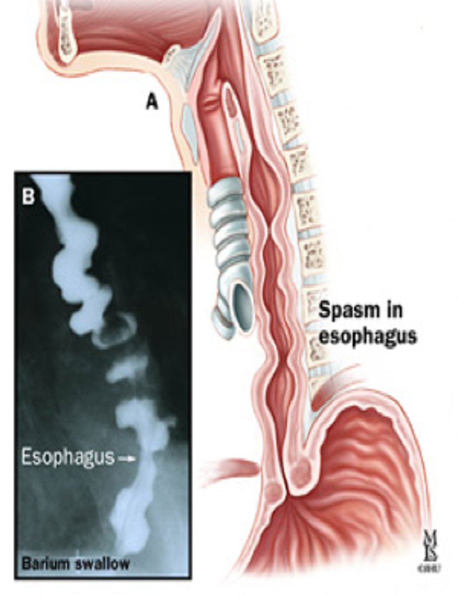 <p><strong><span style="text-decoration:underline">Diffuse Esophageal Spasm</span></strong></p><p>-tx: PPIs for acid suppresion or surgery if refractory</p><p></p><p><strong><em><span style="text-decoration:underline">often confused w/ angina pectoris because CP is relieved with NTG!!!</span></em></strong></p>