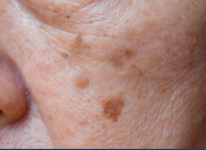<p>EXPECTED AGE-RELATED CHANGES</p><p>Are often referred to as age spots or liver spots due sun exposure.</p><p></p>