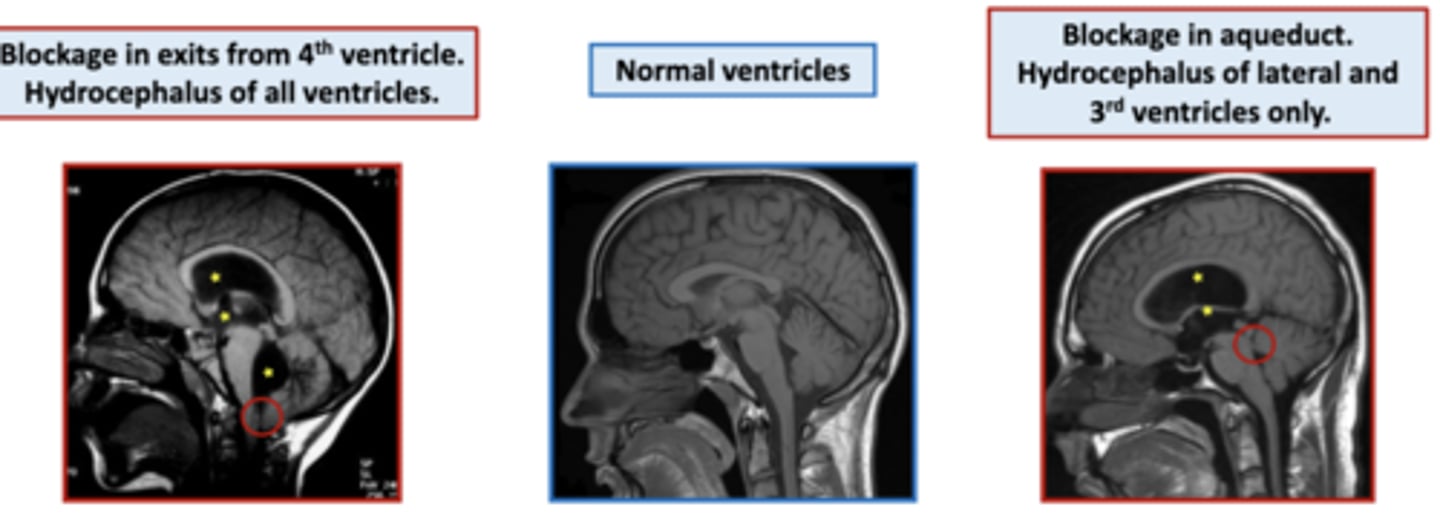 <p>increased CSF in the ventricles and/or the subarachnoid space due to blockage of CSF flow</p><p>wherever the blockage is, there will be increased CSF in the ventricles superior to it </p>