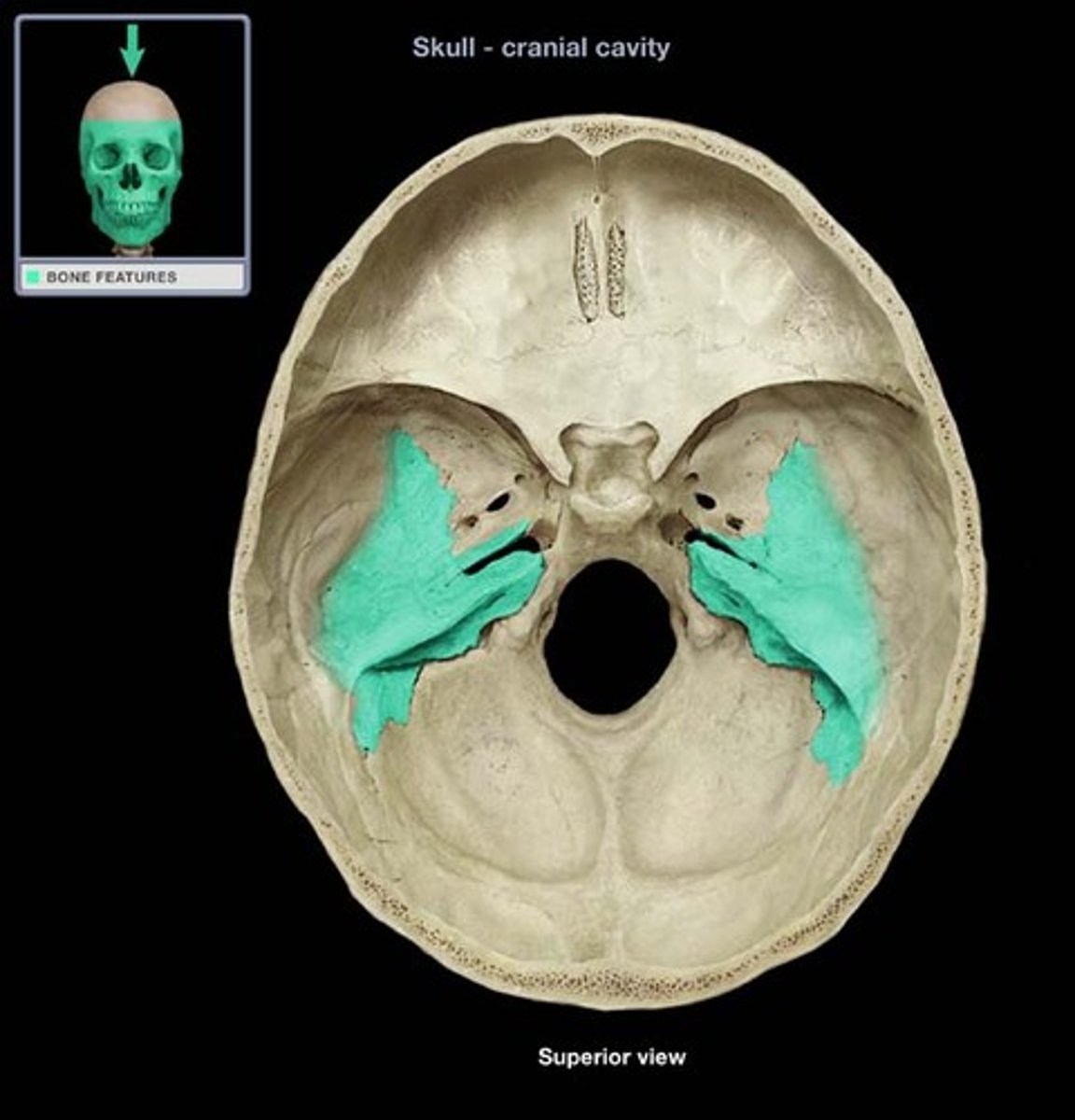 <p>dense bony ridge on interior surface of temporal bone, location of middle and inner ear cavities</p>