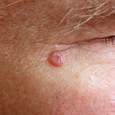 <ul><li><p>Most common form of skin cancer</p></li><li><p>Usually appears as a small, pink bump or patch on the head or neck, and may occur on any part of the body</p></li><li><p>If untreated, the area will begin to open, bleed, or crust repeatedly and can cause extensive damage to the area involved</p></li><li><p>Grows slowly but rarely spread to other parts of the body</p></li></ul>