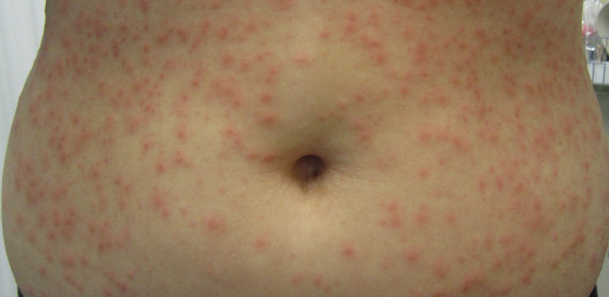 <p>Bacterial Skin Infections:</p><p>- occurs on trunk and extremities after immersion in a hot tub</p><p>- caused by <strong>pseudomonas aeruginosa</strong></p>