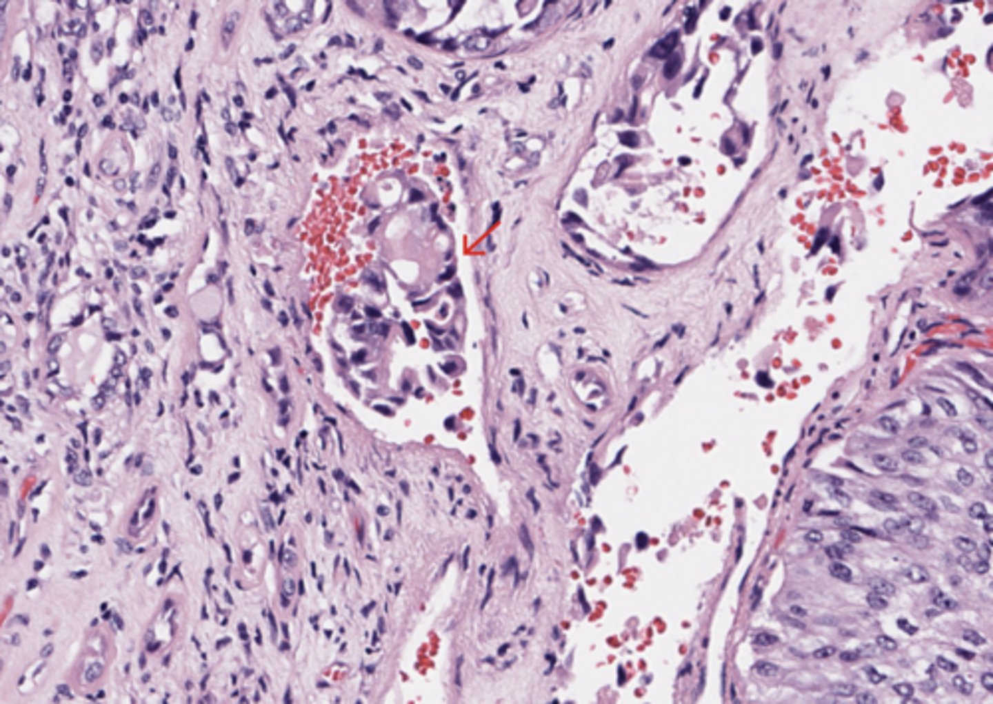 <p>Urothelial tract</p>