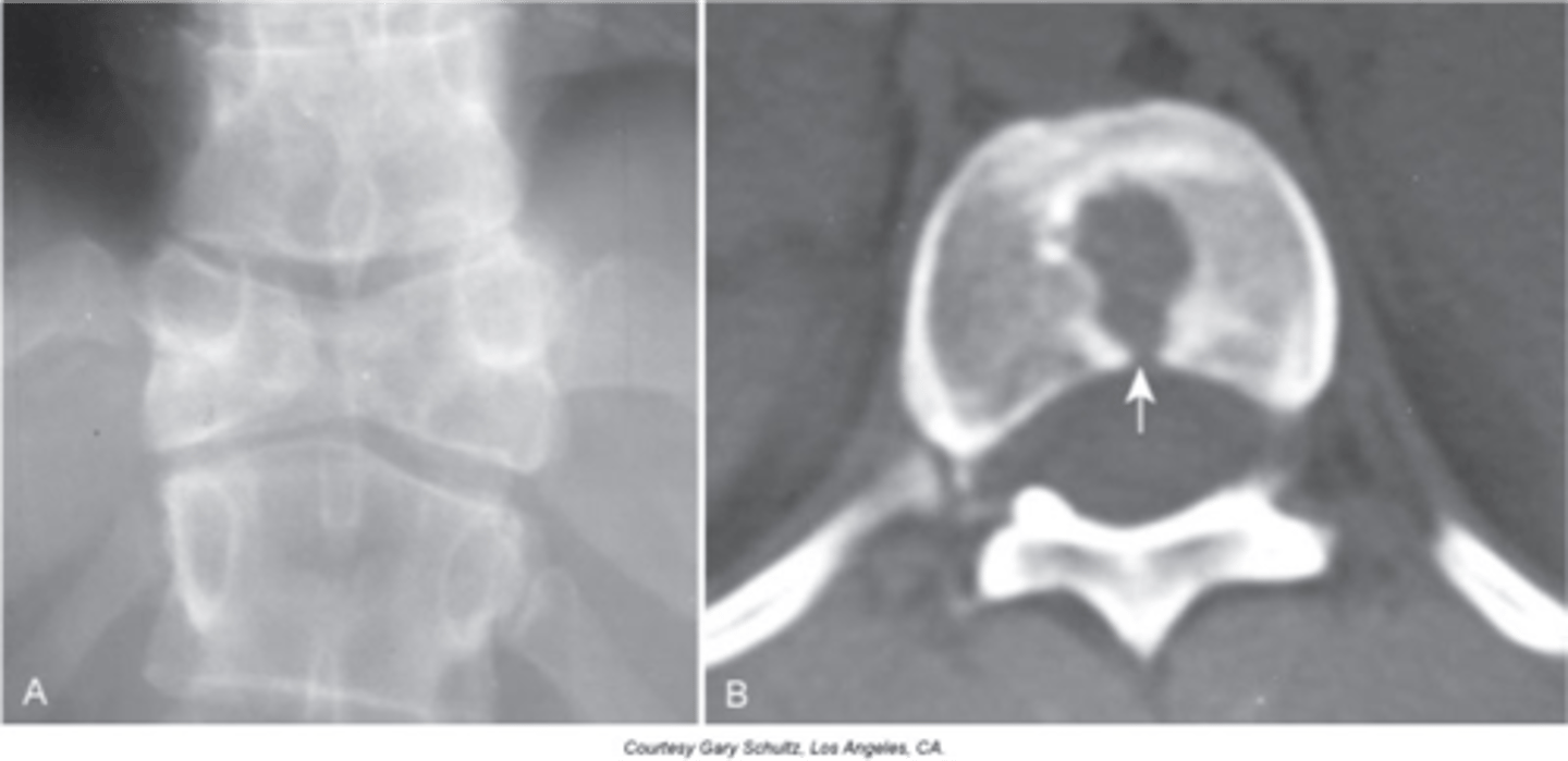 <p>- Failure of the ossification centers to meet in the middle of a vertebral body due to a central cleft</p><p>- The two pieces are not mobile and are attached</p>
