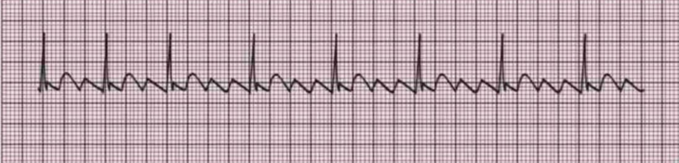 <p>EKG</p>