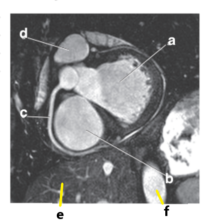 <p>Which letter is the Pulmonary trunk ?</p>