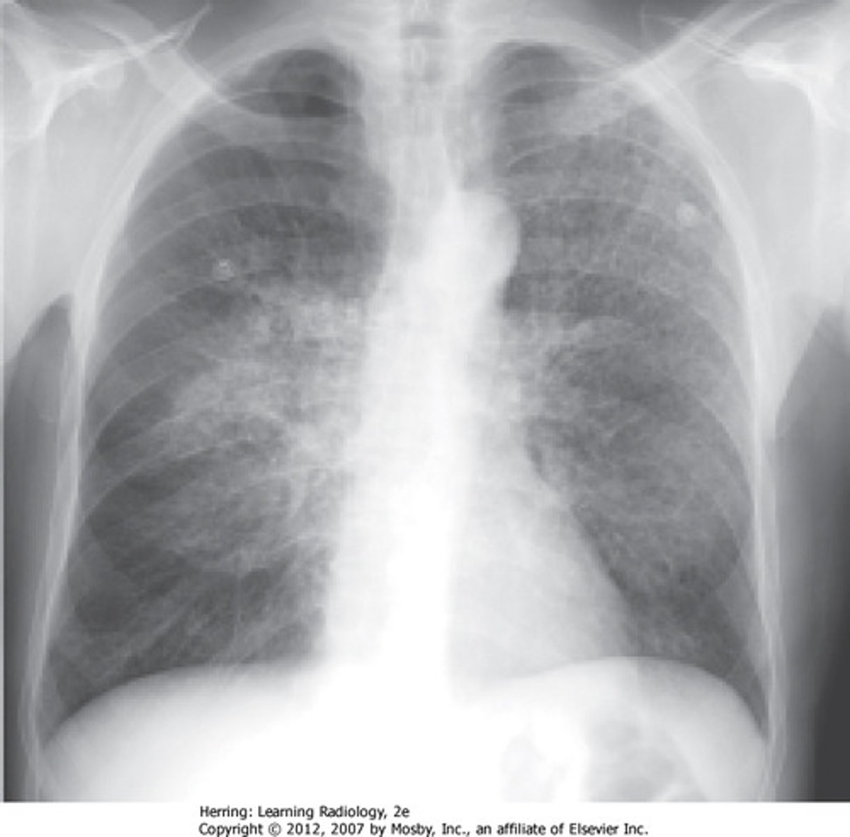 <p>CXR shows •diffuse, bilateral, symmetrical interstitial infiltrates emanating from the hila in a butterfly pattern</p><p>-CT shows patchy areas of ground glass attenuation</p>