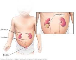 <p><strong>A frantic mother brings her young child into the emergency department. She states that during the evening bath, she noticed a large mass in her child's abdomen. After diagnostic testing, the pediatrician tells the parents that their child has Wilms tumor, stage IV. After the doctor leaves the room, the parents ask the nurse, “What does this mean?” The nurse will respond, “Your child ('s)</strong></p><p>A) “has cancer in his stomach.”</p><p>B) “has cancer in the kidney that has spread most likely to his lungs.”</p><p>C) “will need to undergo surgery to remove both kidneys and then go on dialysis.”</p><p>D) “tumor can be easily treated with chemotherapy. We will start this</p><p>soon.” </p>