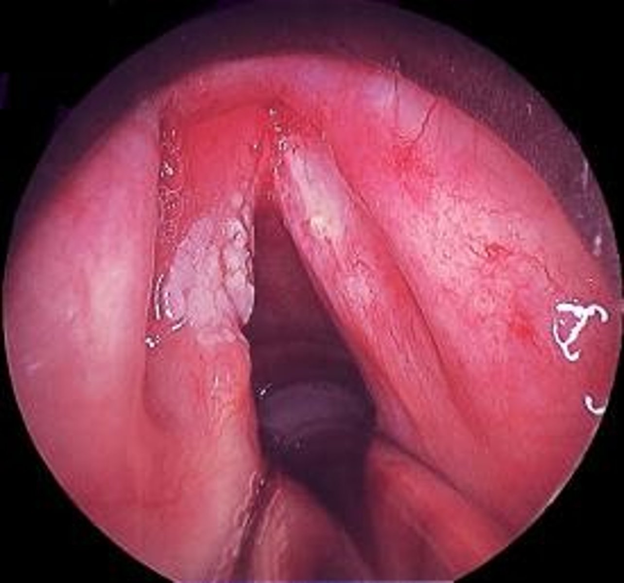 <p>Localized growths on the vocal folds, often bilateral and common in professional voice users.</p>