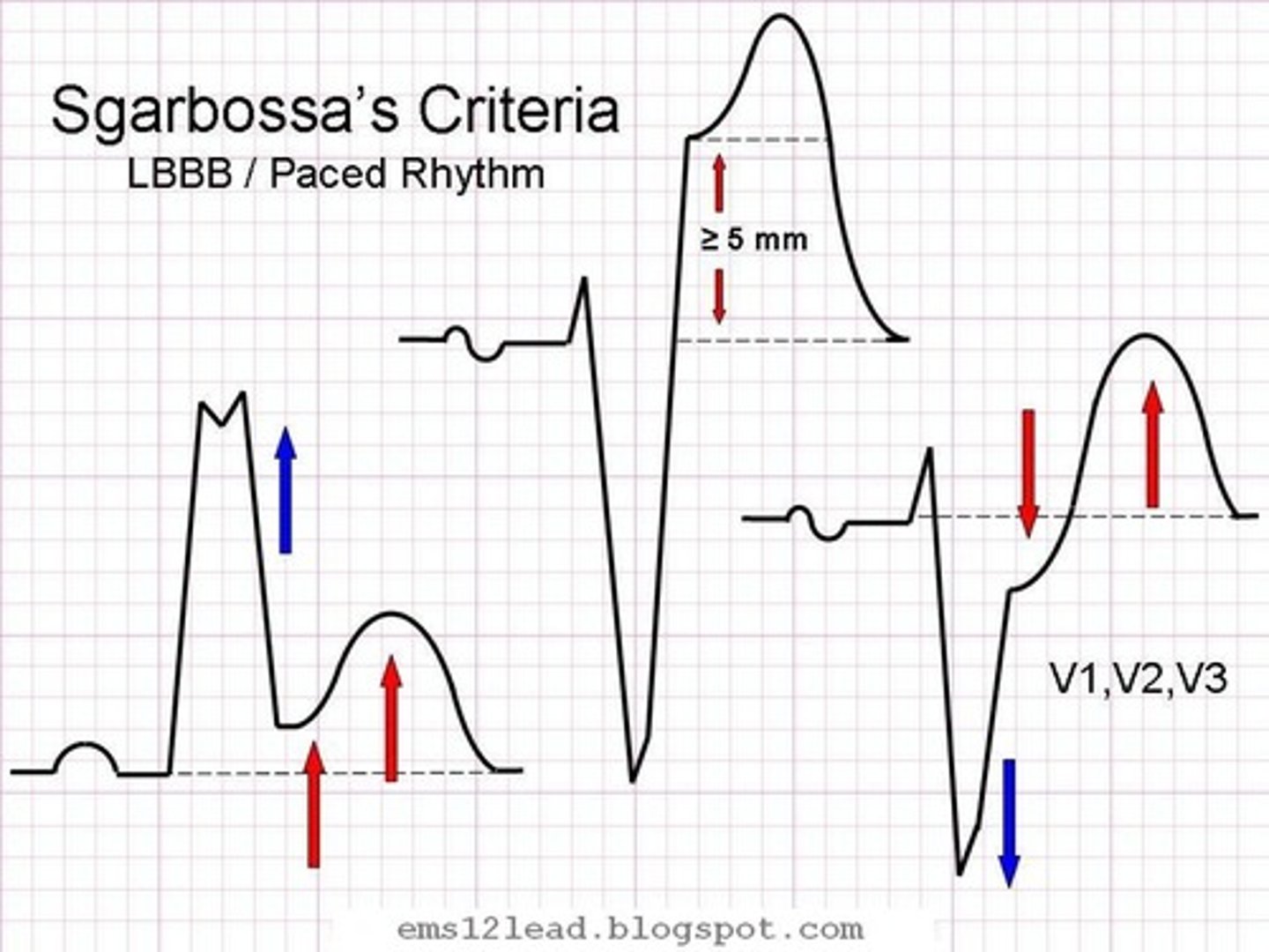 <p>- first published in 1996</p><p>- STEMI and LBBB</p><p>- LBBB has appropriate discordance of ST segment</p>