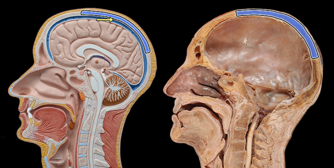 <p>Parietal bone</p>
