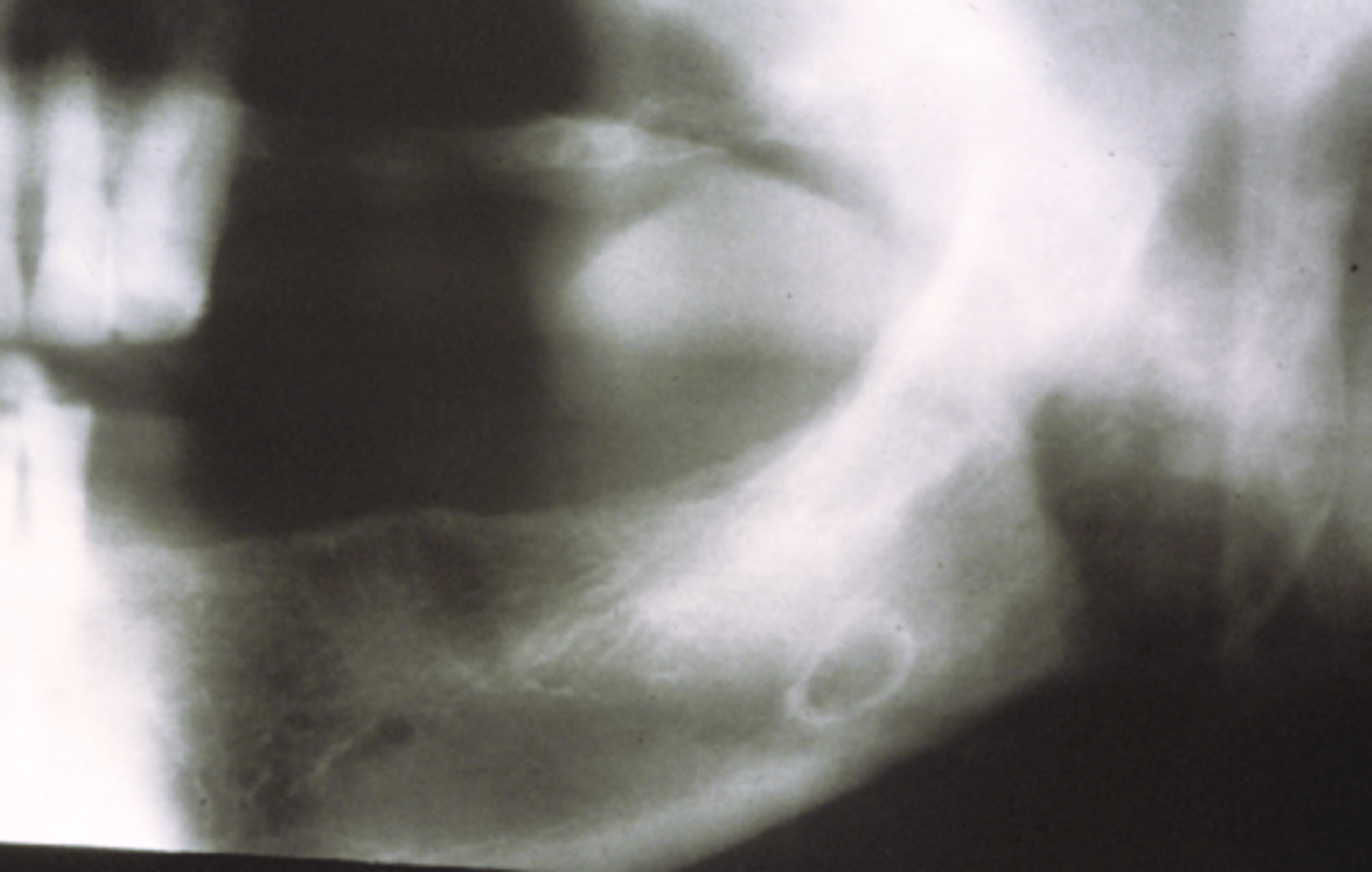 <p>Depression on the mandible at the inferior alveolar canal-submandibular gland</p><p>No treatment indicated</p><p>Made up of Salivary gland tissue</p>