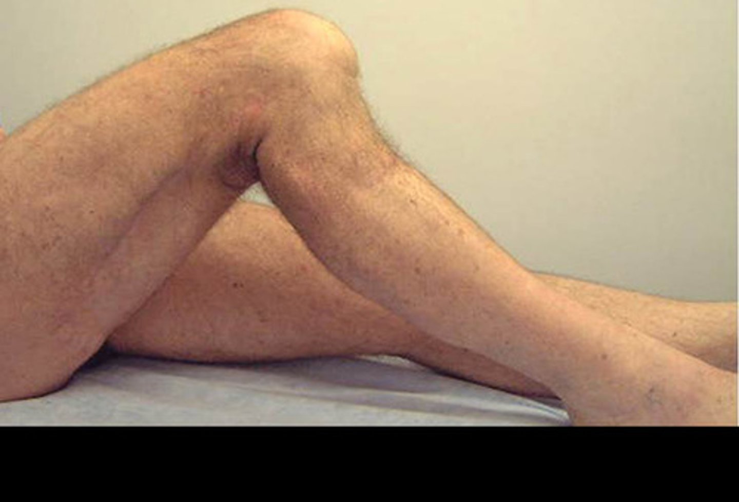 <p>Posterior cruciate ligament integrity</p>