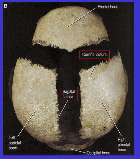 <p>Coronal suture (because kind of align with coronal plane)</p>