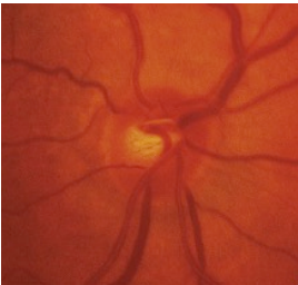 <p>Located <strong>nasal </strong>to the macula and slightly <strong>superior </strong>to the fovea</p><p><strong>~15 degrees</strong> from the fovea</p><p>It is a physiological<strong> blind spot</strong></p><p>Slightly <strong>vertically elongated</strong></p><p>The size of the optic disc ranges</p><p>Different studies range (H x V) • 1.5 H x1.7 V mm </p><p>Lacks all retinal elements except <strong>nerve fiber layer</strong> and<strong> internal limiting membrane</strong></p><p><strong>Müller </strong>cells processes are <strong>replaced </strong>with those of <strong>astrocytes</strong></p>
