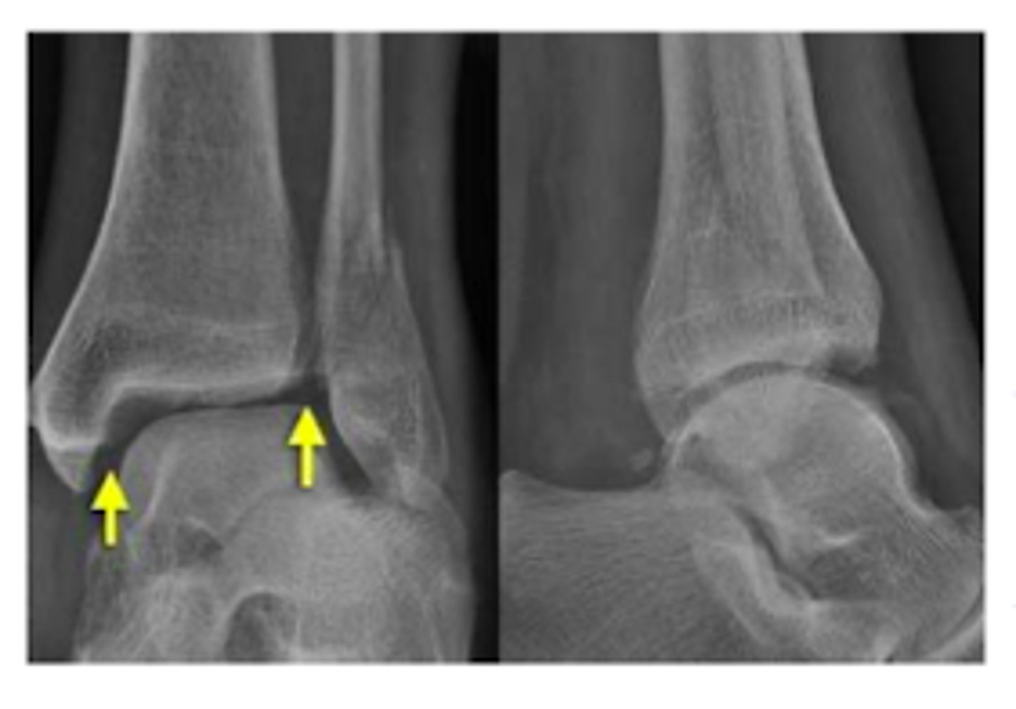 <p>syndesmotic rupture (distal tibiofibular ligament rupture)</p>