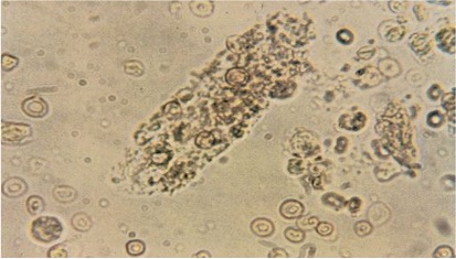 <p>what are mixed cell casts</p>