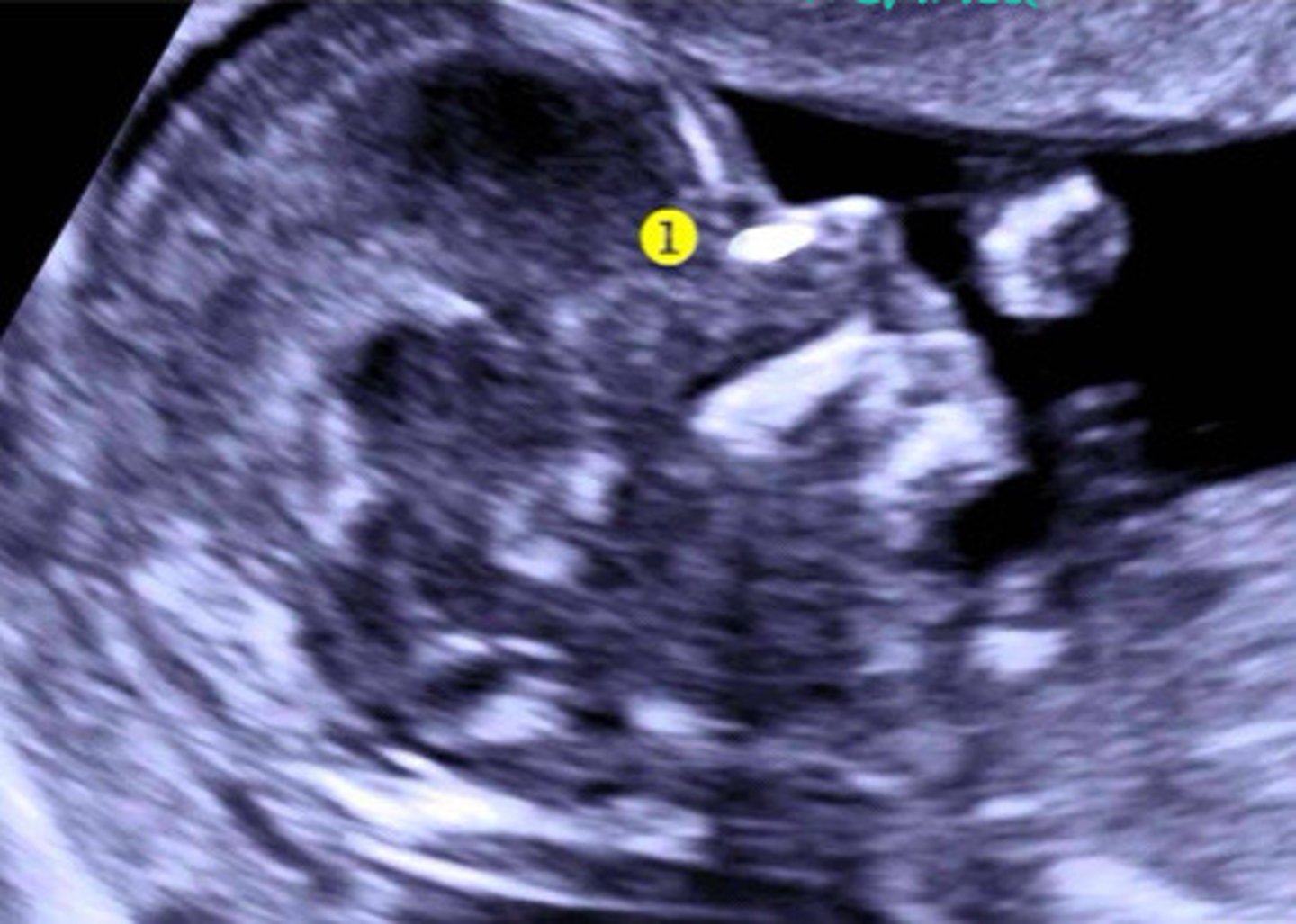 <p>Can you see the nasal bone in this picture</p>