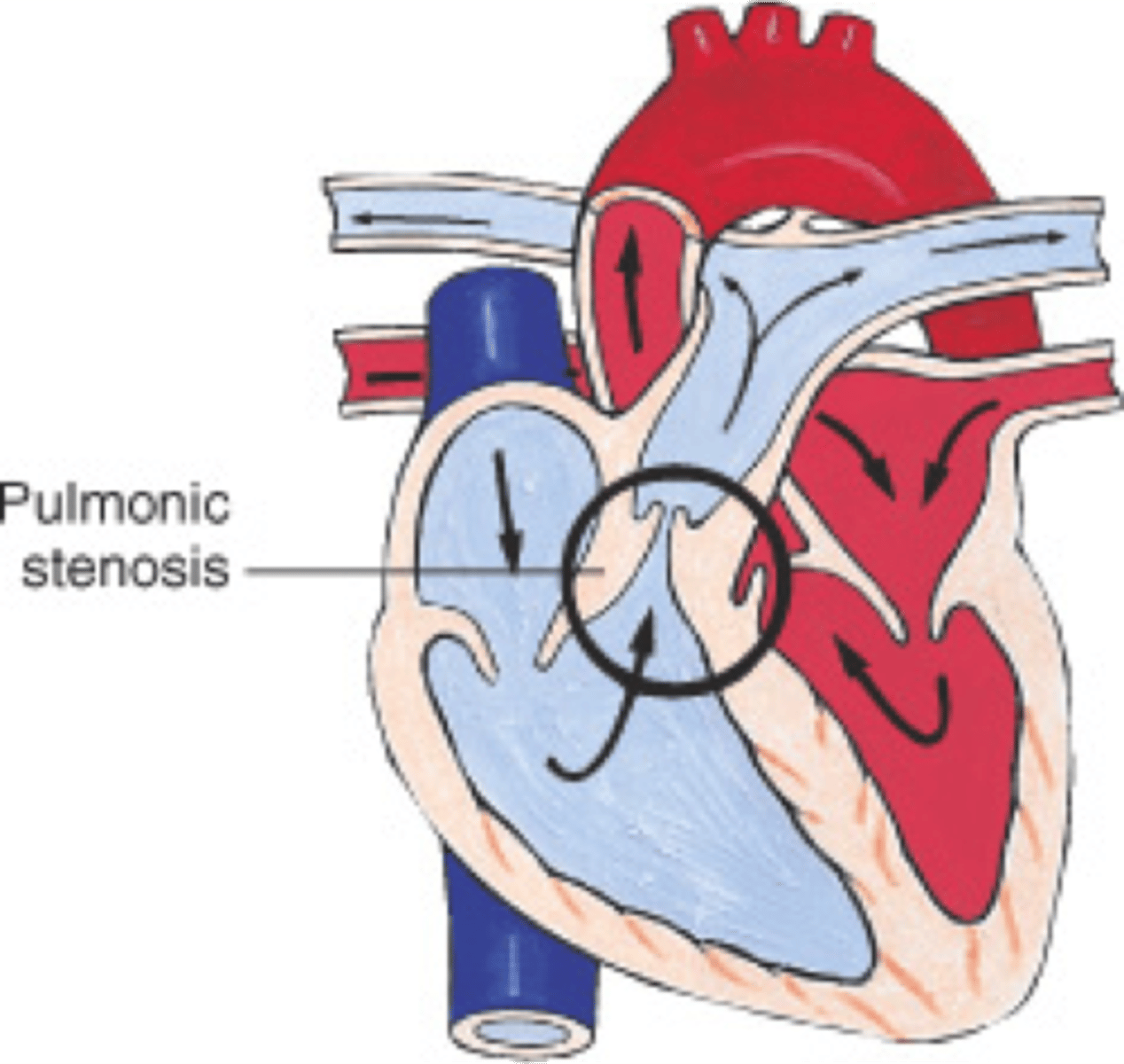 <p>Narrowing of the RV outflow tract</p>