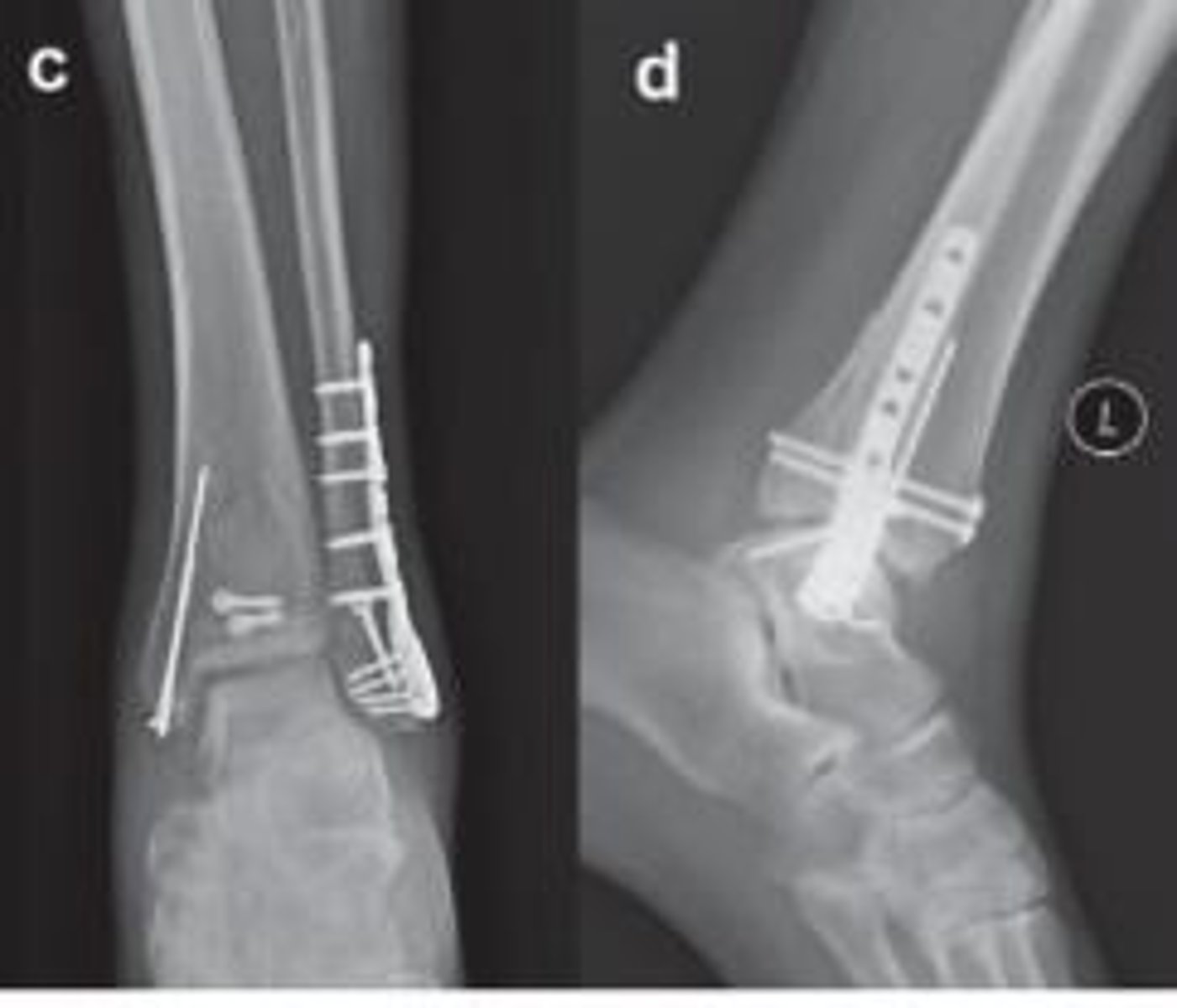 <p>Open Reduction and Internal Fixation (ORIF).</p>